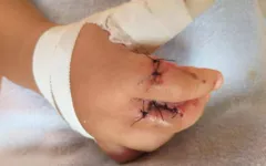 Criança teve três dedos mutilados e precisou passar por cirurgia de reconstrução.