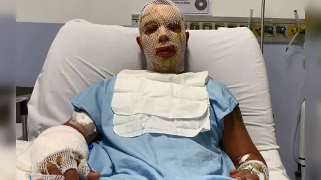 Imagem ilustrativa da notícia Em vídeo, prefeito aparece com rosto enfaixado no hospital e relembra explosão de fogueira