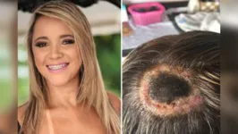 Imagem ilustrativa da notícia Estudante tem parte da cabeça necrosada após fazer luzes no cabelo 