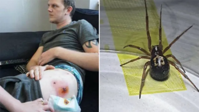 Imagem ilustrativa da notícia Jovem fica sem andar após ser picado cinco vezes por aranha 