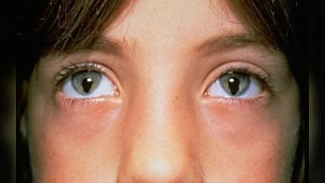 Imagem ilustrativa da notícia Síndrome do olho de gato, descubra mais sobre a doença rara