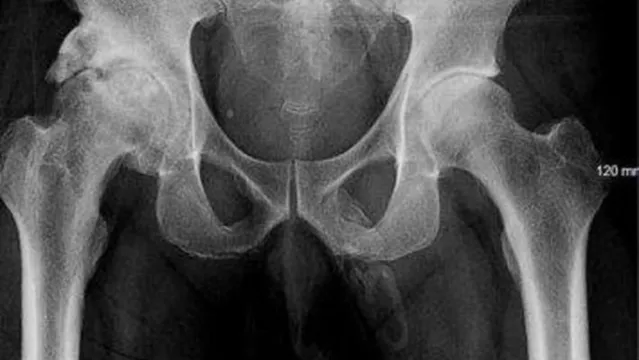 Imagem ilustrativa da notícia Após exames, idoso descobre que pênis está 'virando osso'