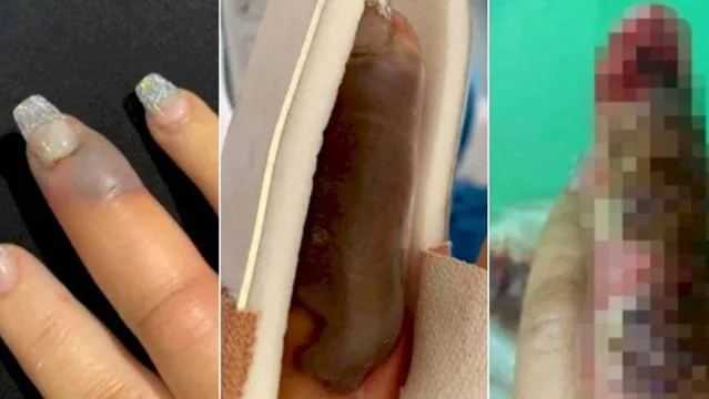 Imagem ilustrativa da notícia Mulher quase perde o dedo após contrair infecção em manicure