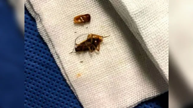 Imagem ilustrativa da notícia Médico encontra 'família' de baratas vivendo em ouvido de jovem de 24 anos