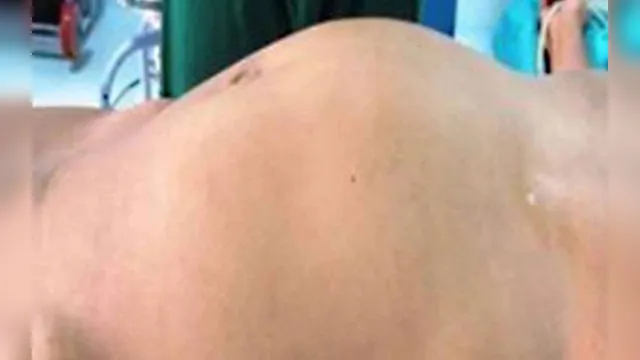 Imagem ilustrativa da notícia Médicos descobrem que “tumor” na barriga de jovem é gêmea parasita