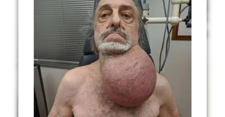 Imagem ilustrativa da notícia Homem remove tumor do tamanho de bola de futebol do pescoço