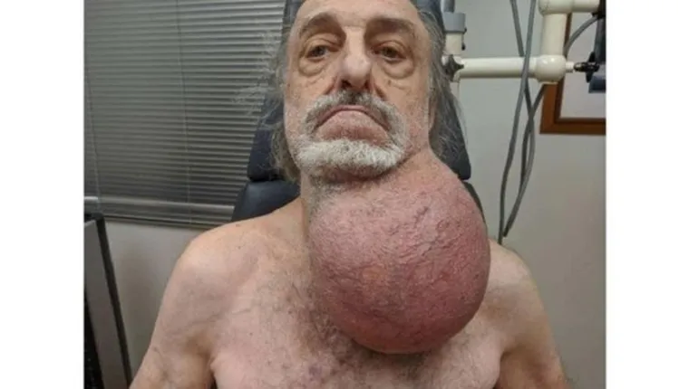 Imagem ilustrativa da notícia Homem remove tumor do tamanho de bola de futebol do pescoço