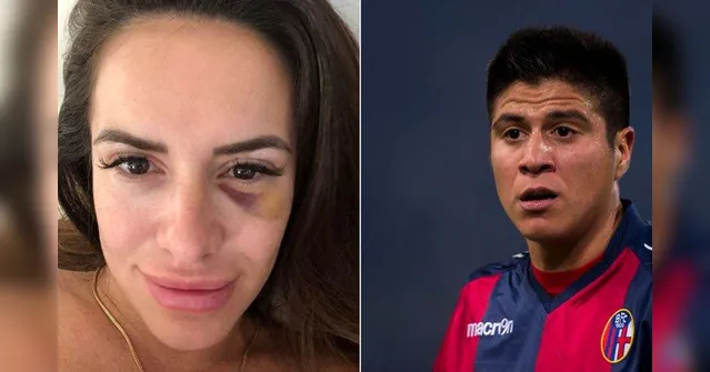 Imagem ilustrativa da notícia Com olho roxo, mulher de ex-jogador do Palmeiras denuncia agressões; assista