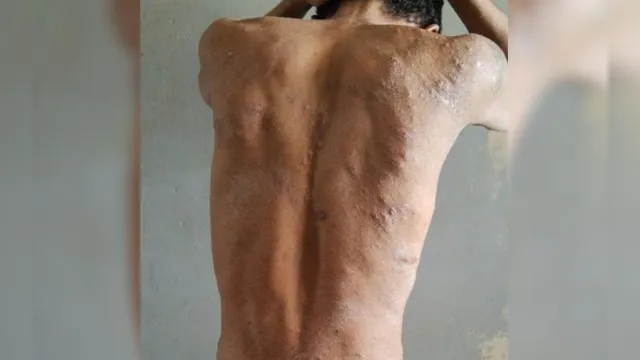 Imagem ilustrativa da notícia OAB denuncia surto de bactéria que provoca feridas e corrosão na pele de presos em Roraima