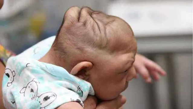 Imagem ilustrativa da notícia Desnutrição materna pode causar microcefalia em bebês