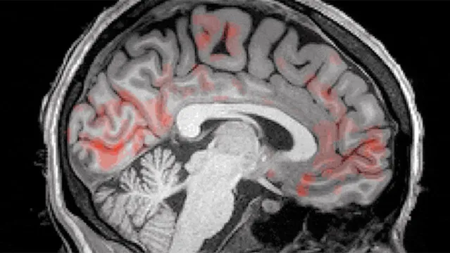 Imagem ilustrativa da notícia Vídeo: líquido espinhal lava o cérebro durante o sono; veja!