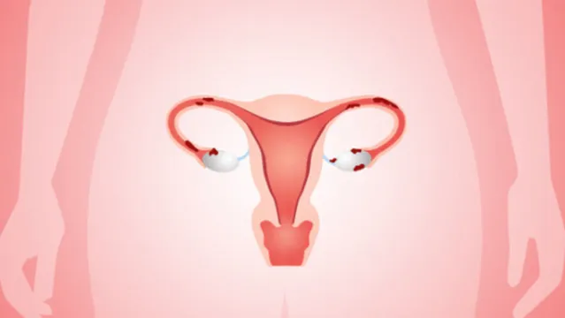 Imagem ilustrativa da notícia Sofre com endometriose? Veja o que é mito ou verdade sobre a doença