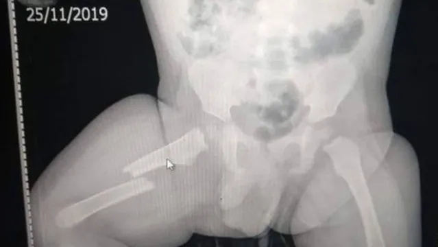 Imagem ilustrativa da notícia Pai tortura e fratura o osso do filho de 11 meses