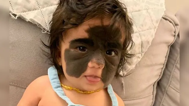 Imagem ilustrativa da notícia Médicos removem parte da mancha no rosto de menina e impressionam
