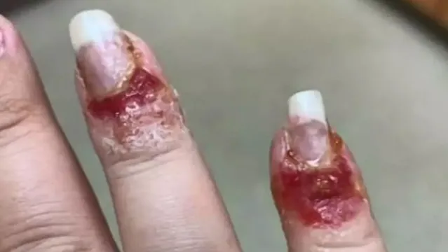 Imagem ilustrativa da notícia Fungos atacam unhas após mulher usar produto desconhecido em salão
