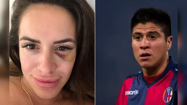 Imagem ilustrativa da notícia Com olho roxo, mulher de ex-jogador do Palmeiras denuncia agressões; assista