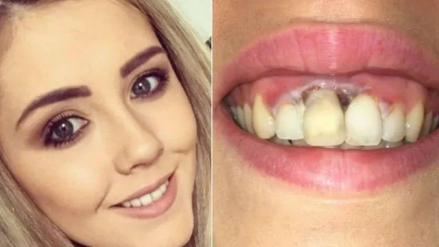 Imagem ilustrativa da notícia Mulher fica com queimadura na gengiva após clareamento dos dentes