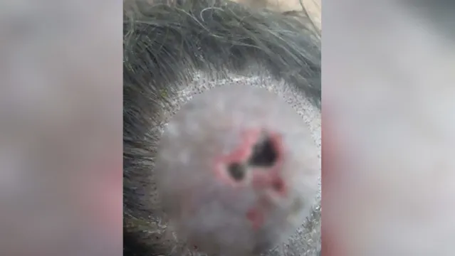 Imagem ilustrativa da notícia Imagem forte: mulher encontra larvas na cabeça e diz que marido estava 'sendo comido vivo' 
