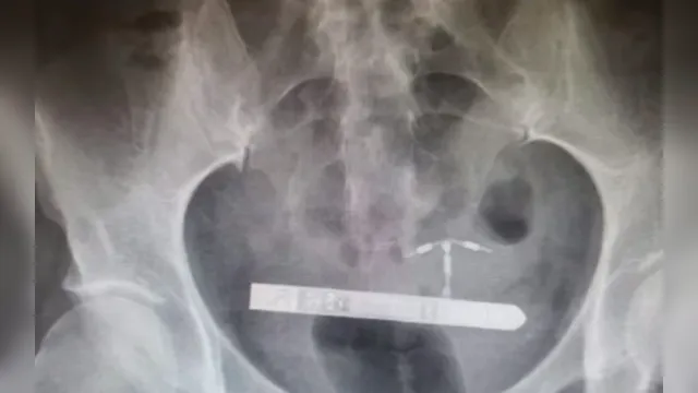 Imagem ilustrativa da notícia Mulher passa por cirurgia após vibrador ficar preso em sua bexiga