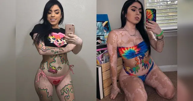 Imagem ilustrativa da notícia Jovem com vitiligo promove autoaceitação criando ilustrações sobre a pele