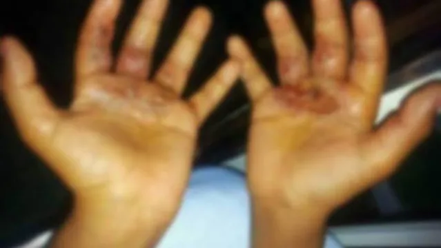 Imagem ilustrativa da notícia Mãe queima mãos da filha como castigo por ela furtar R$ 50