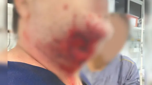 Imagem ilustrativa da notícia Paciente surta e arranca pedaço de rosto de médico com mordida