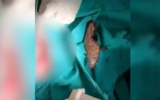 O homem afirma que se sentou sem querer no animal, apesar dos médicos não acreditarem