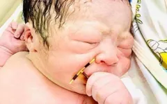 Imagem ilustrativa da notícia Bebê nasce segurando DIU que mãe usou para não engravidar