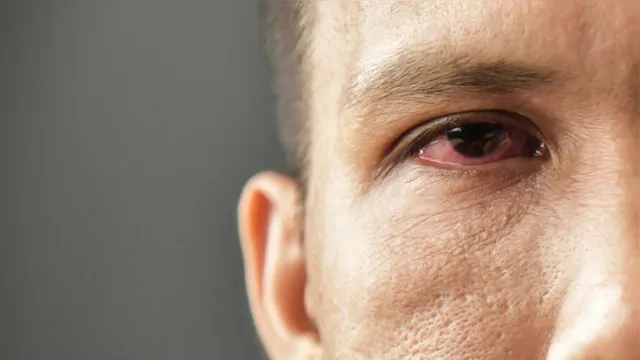 Imagem ilustrativa da notícia Síndrome do 'Olho Seco' já afeta 15% da população
