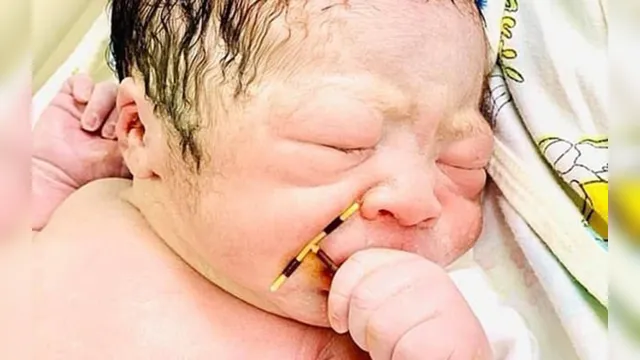 Imagem ilustrativa da notícia Bebê nasce segurando DIU que mãe usou para não engravidar