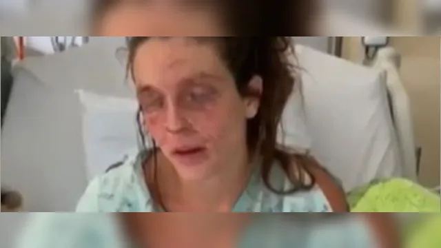 Imagem ilustrativa da notícia Jovem fica cega após fazer maquiagem caseira e queimar os olhos