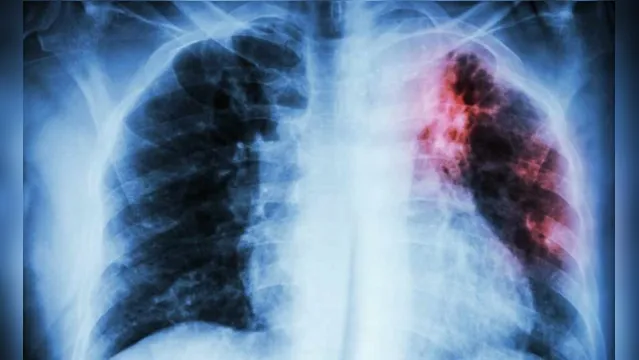 Imagem ilustrativa da notícia China alerta para surto de pneumonia "desconhecida" mais mortal que a COVID-19