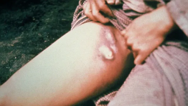 Imagem ilustrativa da notícia Peste bubônica mata adolescente e coloca dezenas em quarentena