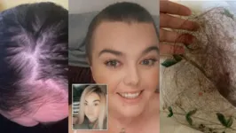 Grace relatou perda de cabelo após contrair a covid-19