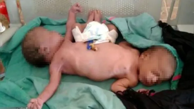 Imagem ilustrativa da notícia Gêmeas nascem com duas pernas e quatro braços e desafiam médicos