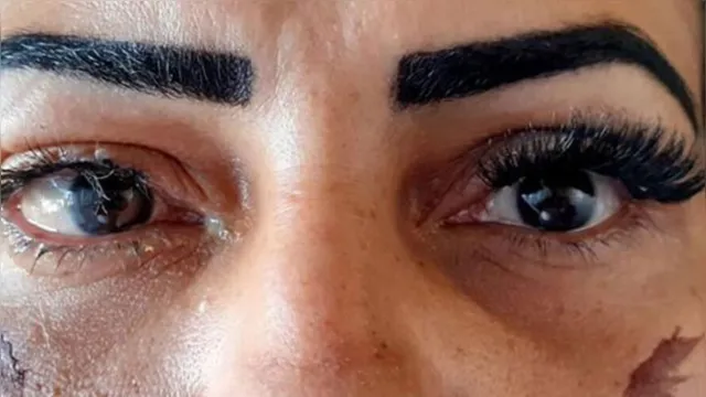 Imagem ilustrativa da notícia Mulher sofre lesões graves nos olhos após colocar cílios postiços, veja 