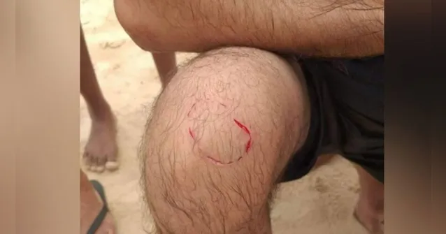 Imagem ilustrativa da notícia Mordidas, feridas e dedo amputado: série de ataques de peixes em praia paraense preocupa banhistas