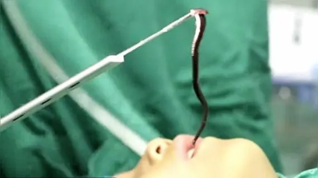 Imagem ilustrativa da notícia Médicos retiram sanguessuga viva da garganta de criança