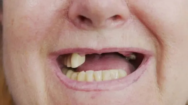 Imagem ilustrativa da notícia Mulher perde 15 dentes após instalação incorreta de aparelho odontológico