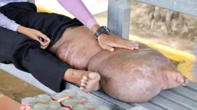 Imagem ilustrativa da notícia Homem fica com a perna deformada após picadas de mosquito 