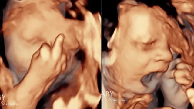 Imagem ilustrativa da notícia Bebê viraliza ao mostrar 'dedo do meio' em ultrassom
