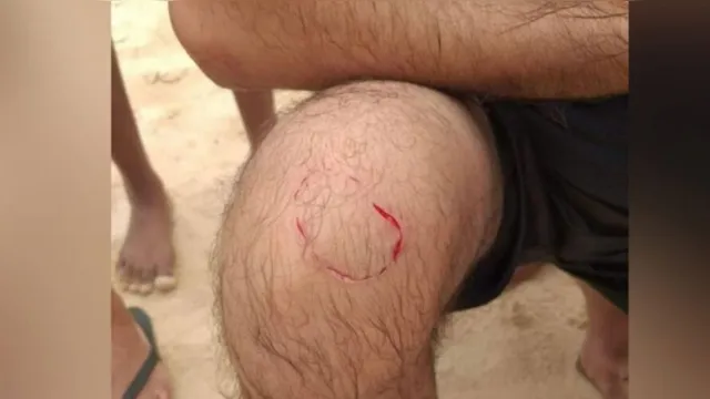 Imagem ilustrativa da notícia Mordidas, feridas e dedo amputado: série de ataques de peixes em praia paraense preocupa banhistas