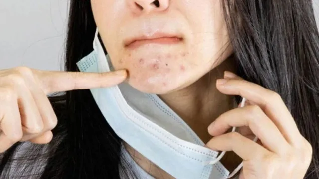 Imagem ilustrativa da notícia Saiba como evitar a "maskne", acne causada pelo uso da máscara de proteção