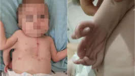 O menino também sofre com a Síndrome da Hipoplasia do Coração Esquerdo