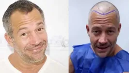 Malvino Salvador mostrou o início do procedimento de implante capilar.