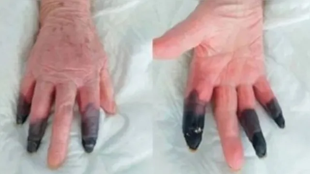 Imagem ilustrativa da notícia Paciente tem três dedos amputados após sofrer reação rara à Covid-19 