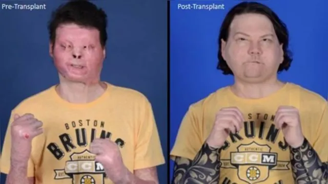 Imagem ilustrativa da notícia Rapaz de 22 anos é a 1ª pessoa a sobreviver a transplante de mãos e rosto