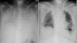 Radiografias mostram o tórax da paciente antes e depois do transplante