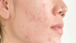 Imagem ilustrativa da notícia Acne: fatores psicológicos e comportamentais podem desencadear inflamação