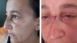 Mulher foi atacada com bexiga enquanto caminhava pela rua. Além de ter um corte no nariz, ela pegou uma infecção ocular.